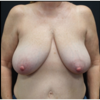 55-64 year old woman treated with Breast Lift before 3130089