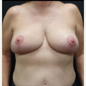55-64 year old woman treated with Breast Lift after 3130089