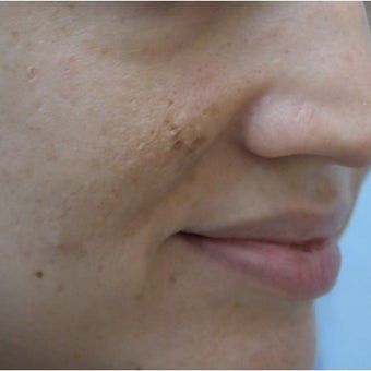 InMode Fractora for acne scarring and discoloration on cheeks before 1982743