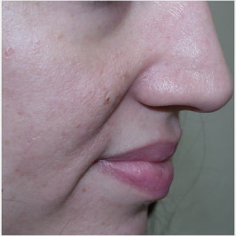 InMode Fractora for acne scarring and discoloration on cheeks after 1982743