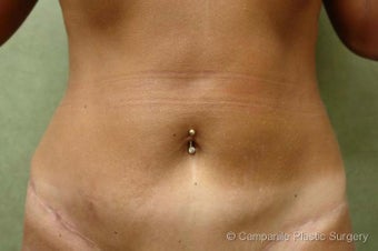 Tummy Tuck Revision before 696114
