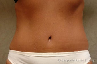 Tummy Tuck Revision after 696114