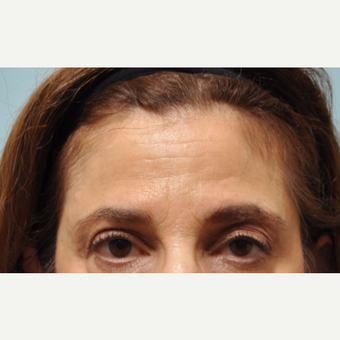 55-64 year old man treated with Eyelid Surgery after 3458852