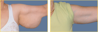 55-64 year old woman treated with Arm Lift before 3749774