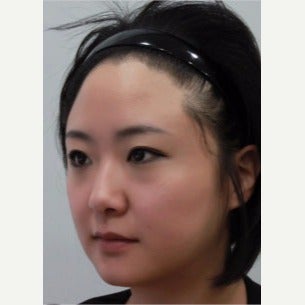 25-34 year old woman treated with Forehead Reduction with Hair Transplant after 1973841