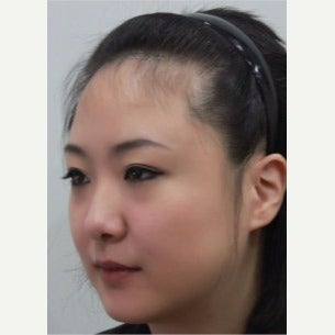 25-34 year old woman treated with Forehead Reduction with Hair Transplant before 1973841