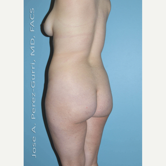 18-24 year old woman treated with Brazilian Butt Lift before 3056478