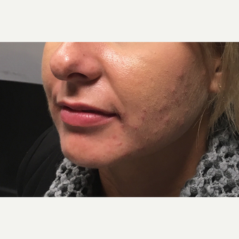 25-34 year old woman treated with Juvederm Ultra before 3802203