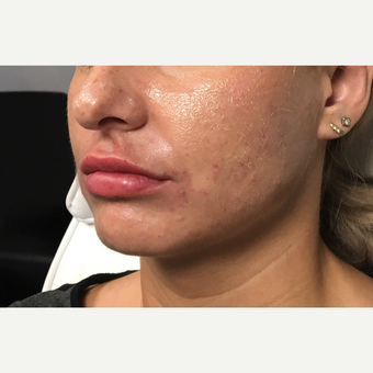 25-34 year old woman treated with Juvederm Ultra after 3802203