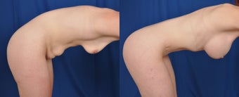 25-34 year old woman treated with Mommy Makeover 3542975