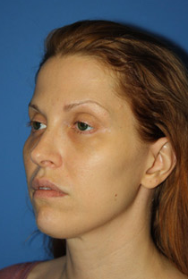 Ulthera after 1109826