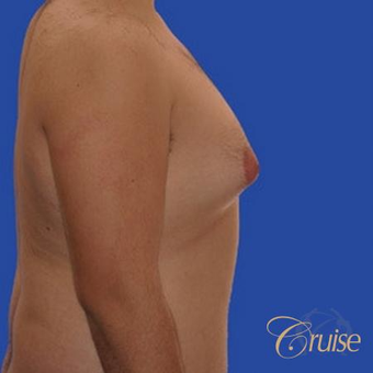 34 yr old man treated with male breast reduction surgery to get rid of his moderate gynecomastia before 3502198