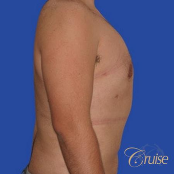 34 yr old man treated with male breast reduction surgery to get rid of his moderate gynecomastia after 3502198