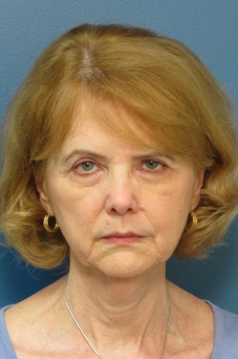 Brow Lift, Facelift & Lower Eyelid Surgery before 338627