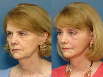 Brow Lift, Facelift & Lower Eyelid Surgery 338627