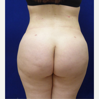 27 y/o female - 1500cc per side Lipo abdomen, flanks, back with fat transfer to the buttocks after 3433766