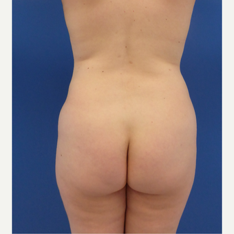 27 y/o female - 1500cc per side Lipo abdomen, flanks, back with fat transfer to the buttocks before 3433766