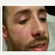 25-34 year old man treated with Rhinoplasty after 3687149