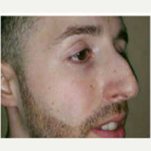 25-34 year old man treated with Rhinoplasty before 3687149