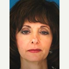 45-54 year old woman treated with Revision Rhinoplasty before 1847712