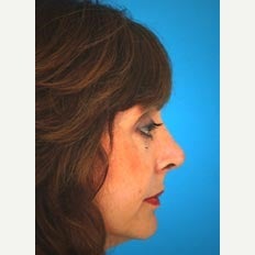 45-54 year old woman treated with Revision Rhinoplasty 1847712