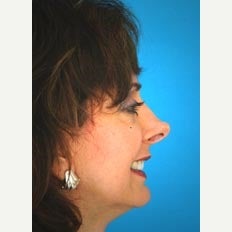 45-54 year old woman treated with Revision Rhinoplasty 1847712