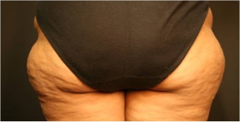 SmartLipo MPX before 686135