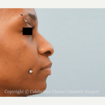 25-34 year old woman treated with African American Rhinoplasty before 3853523