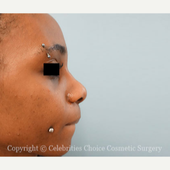 25-34 year old woman treated with African American Rhinoplasty after 3853523