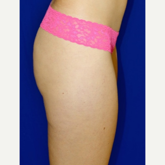 35-44 year old woman treated with Fat Transfer before 3055569