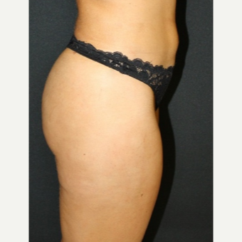 35-44 year old woman treated with Fat Transfer after 3055569