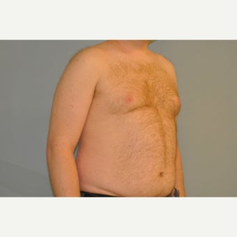 25-34 year old man treated with Male Breast Reduction 1759173
