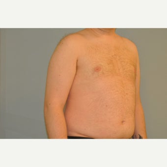 25-34 year old man treated with Male Breast Reduction 1759173