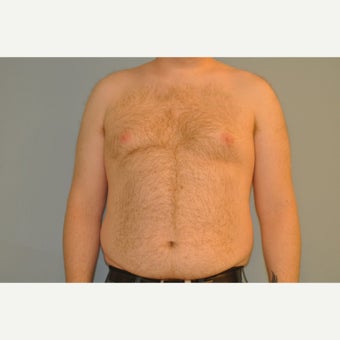 25-34 year old man treated with Male Breast Reduction before 1759173