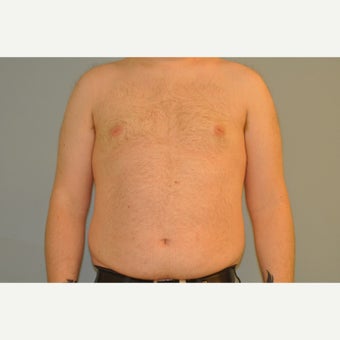 25-34 year old man treated with Male Breast Reduction after 1759173