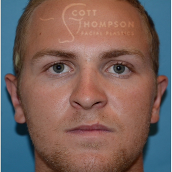 18-24 year old man treated with Ear Surgery after 3294232