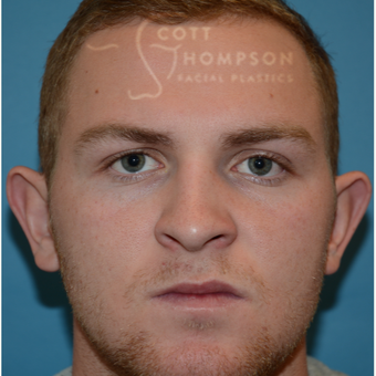 18-24 year old man treated with Ear Surgery before 3294232