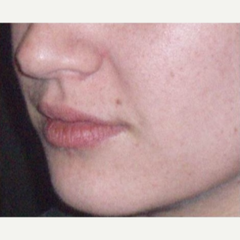 25-34 year old woman treated with Juvederm after 3153698