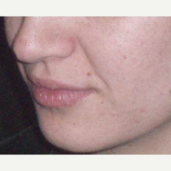 25-34 year old woman treated with Juvederm before 3153698