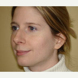 25-34 year old woman treated with Rhinoplasty before 3372117
