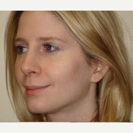 25-34 year old woman treated with Rhinoplasty after 3372117