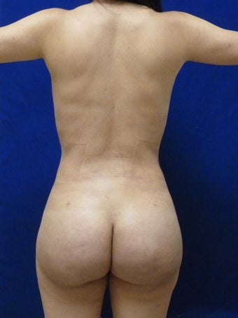 30 y.o. female – Liposuction of abdomen, flanks, & back with fat transfer to buttocks– 1150 cc per side after 1436257