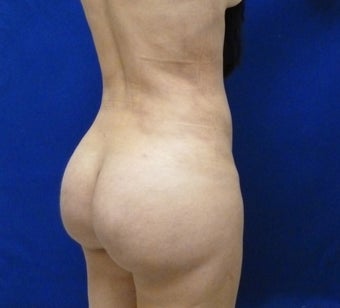 30 y.o. female – Liposuction of abdomen, flanks, & back with fat transfer to buttocks– 1150 cc per side 1436257