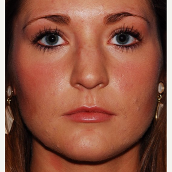 25-34 year old woman treated with Jaw Reduction before 3624514