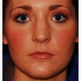 25-34 year old woman treated with Jaw Reduction after 3624514