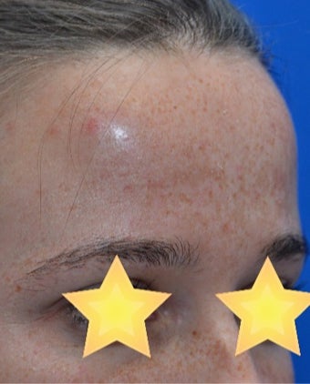 25-34 year old woman treated with Fractional Laser before 3141128