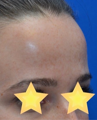 25-34 year old woman treated with Fractional Laser after 3141128