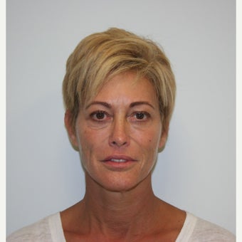 49 Year Old Treated with Fat Grafting to Face before 1671299