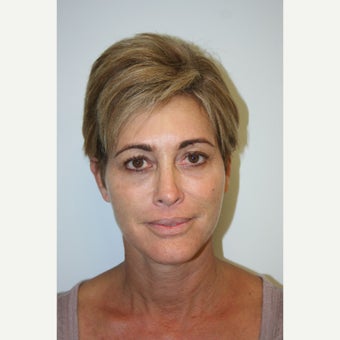 49 Year Old Treated with Fat Grafting to Face after 1671299