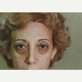 Eyelid rejuvenation-Chemical Peel and Lower Blepharoplasty before 1645252